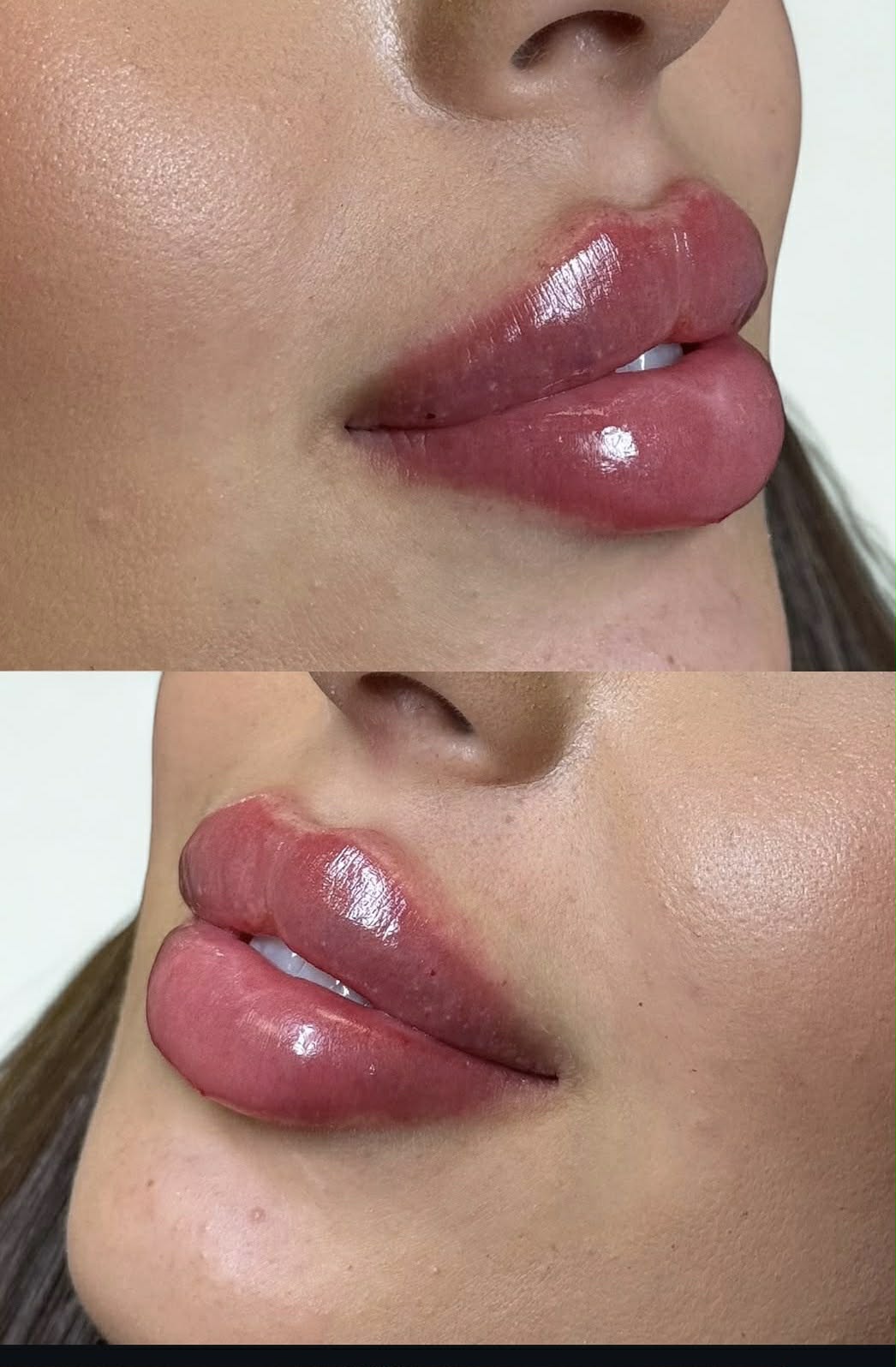 Metamorfoza ust WB Aesthetic